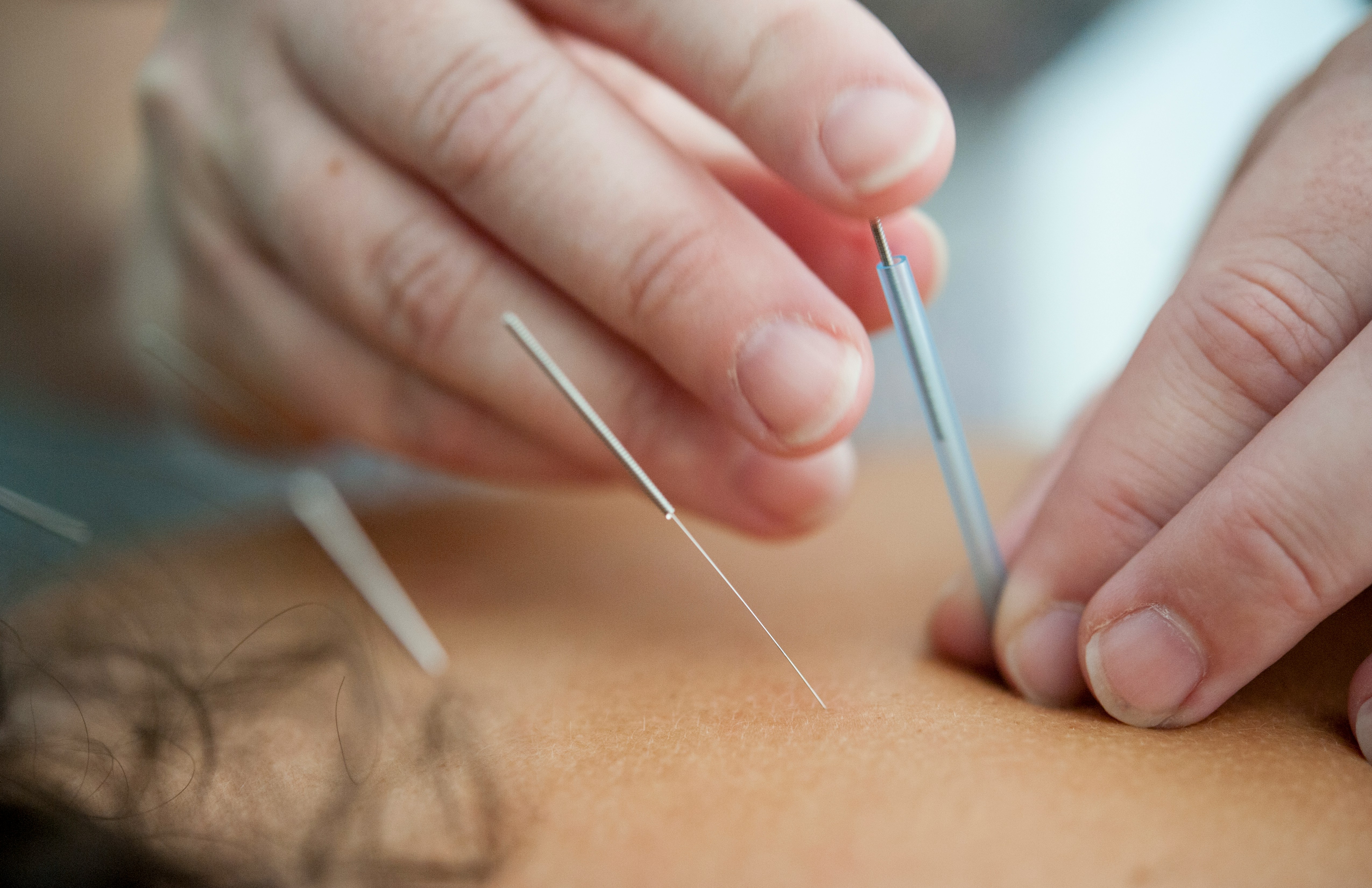 Acupuncture needles in a calm treatment setting